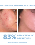 ANTI-BLEMISH KIT