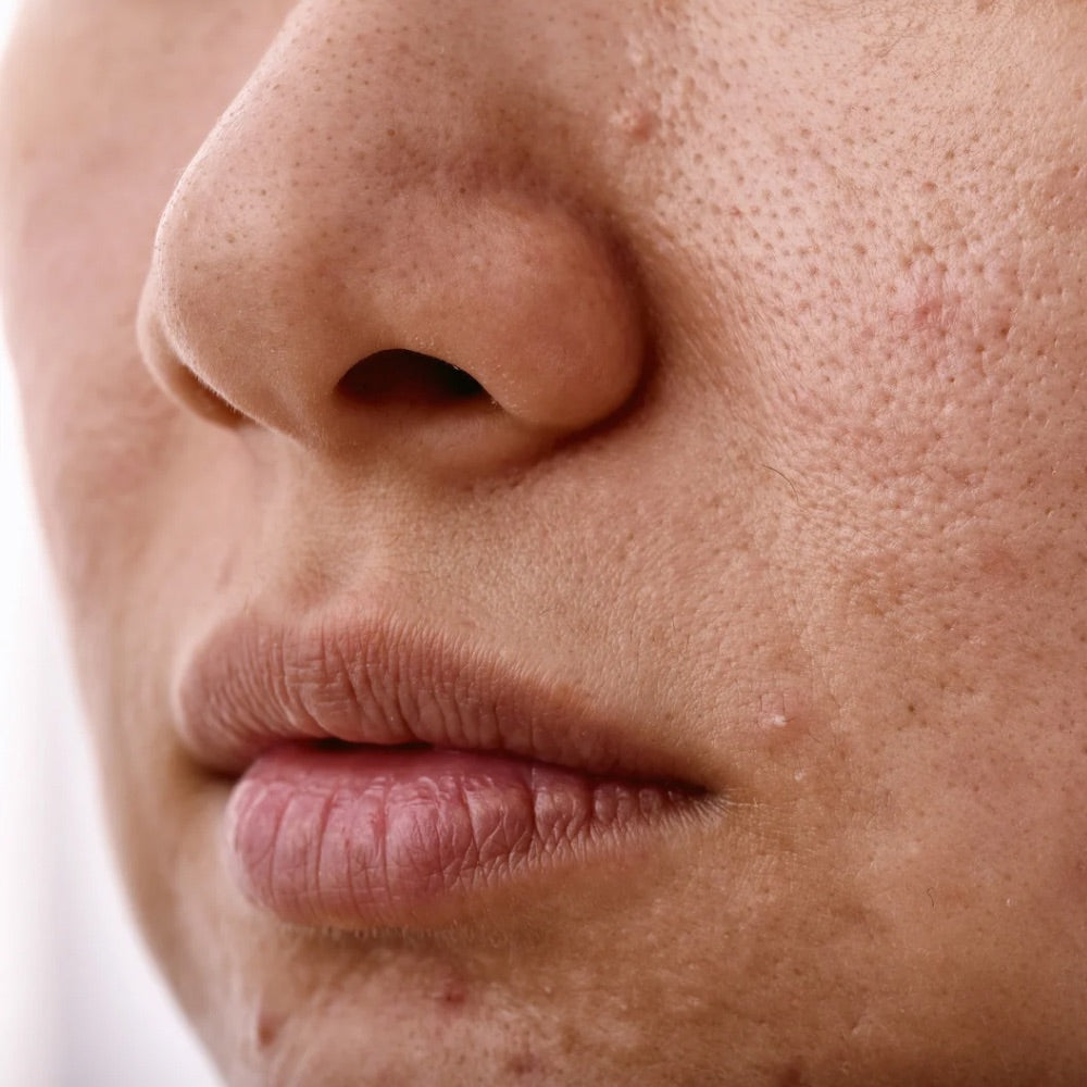Pimple Face Before