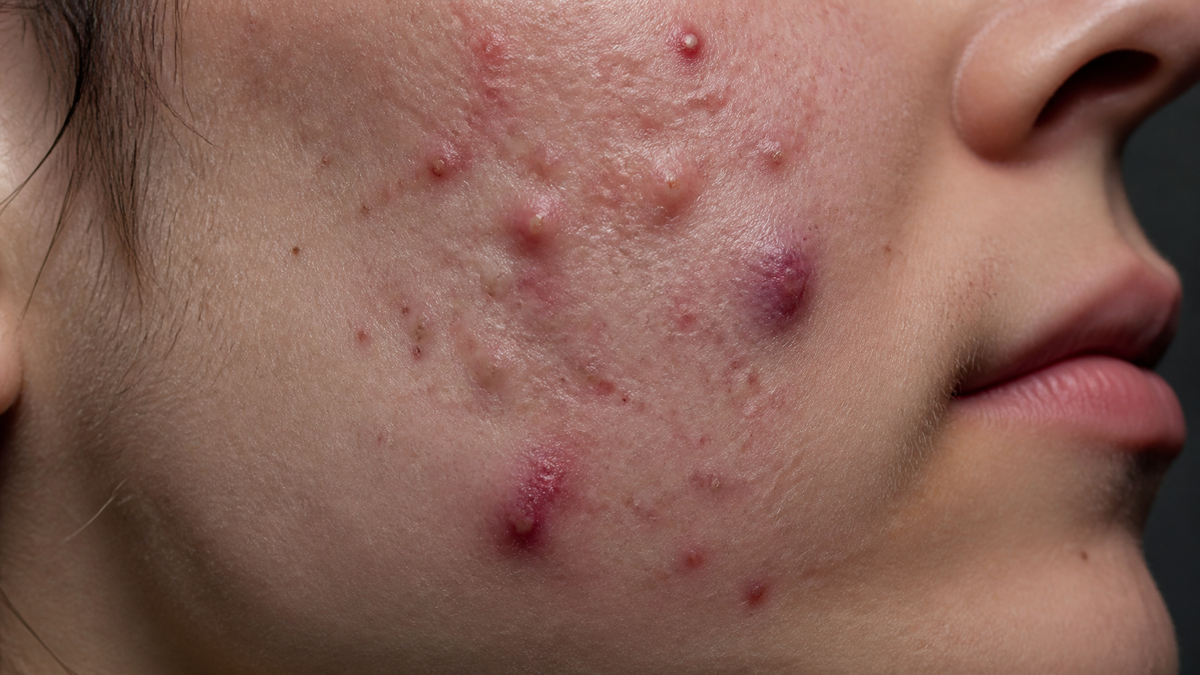 The Reality of Healing Acne: A Realistic Timeline