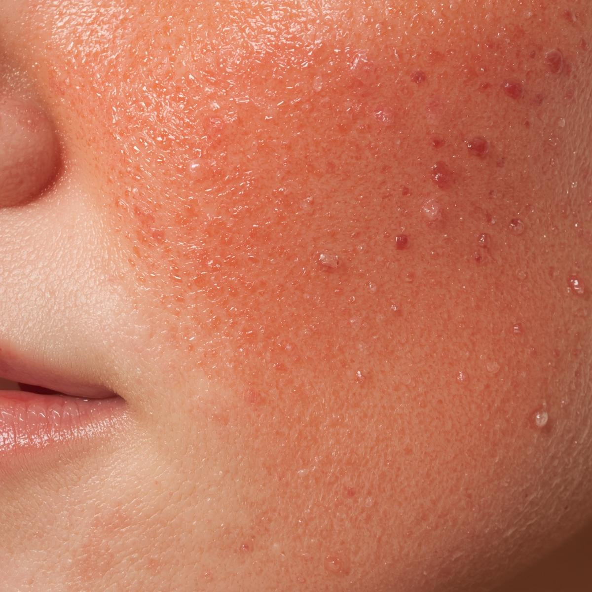 image or redness rosacea skin