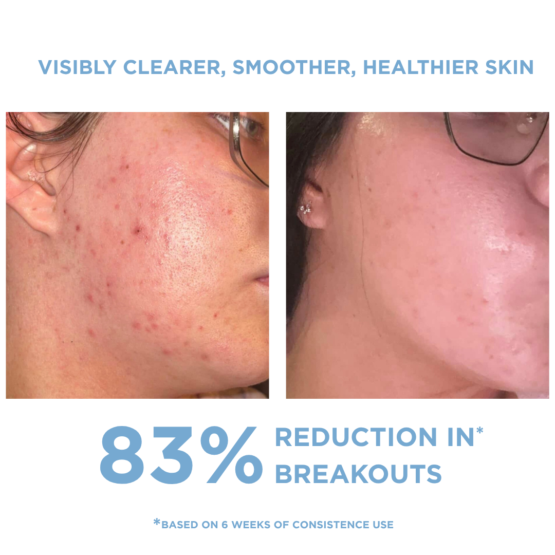 ANTI-BLEMISH KIT