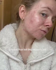 ANTI-BLEMISH KIT